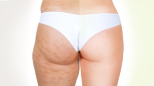 statistica-cellulite-donne