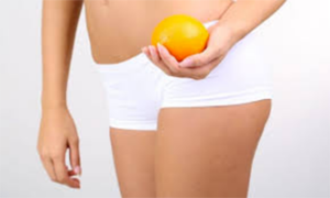 cellulite